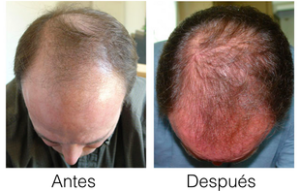 antes y despues advanced hair complex