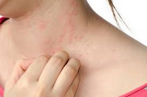 alergias de la piel